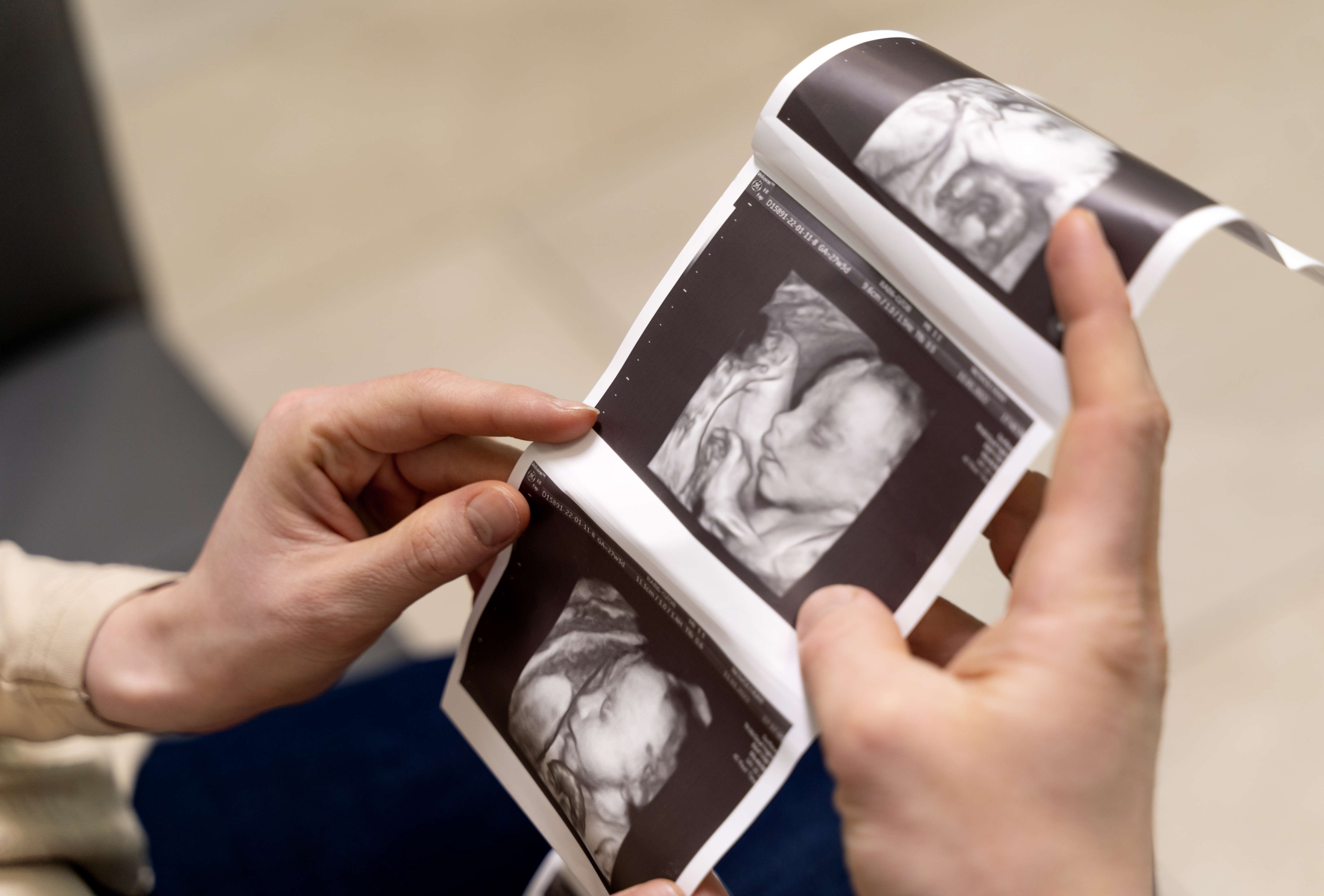 3D Obstetric Ultrasound in Sholinganallur